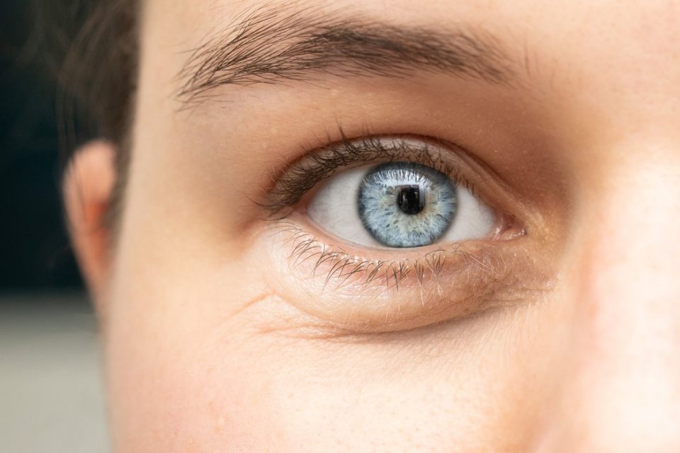 Perawatan Mata: Cara Mengatasi Mata Bengkak dan Kerutan